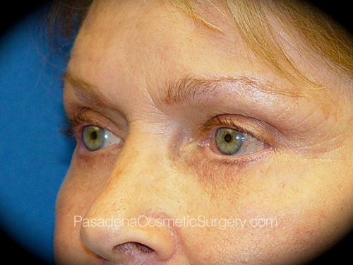 Eyelid Surgery Patient 04 After - 2