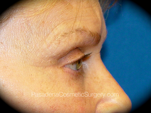 Eyelid Surgery Patient 04 After - 3