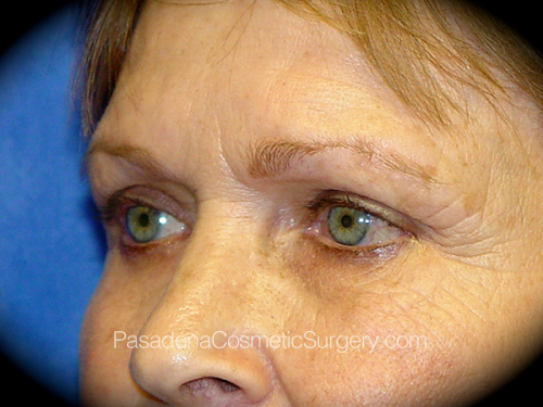 Eyelid Surgery Patient 04 Before - 2
