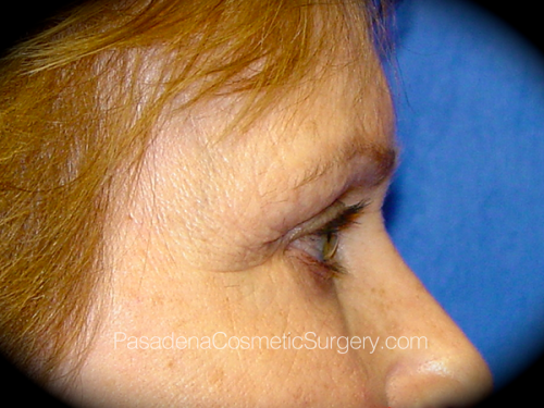 Eyelid Surgery Patient 04 Before - 3