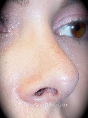 Rhinoplasty Patient 01 After - 2