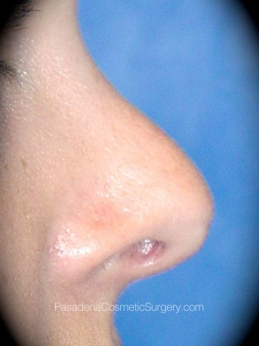 Rhinoplasty Patient 01 After - 3