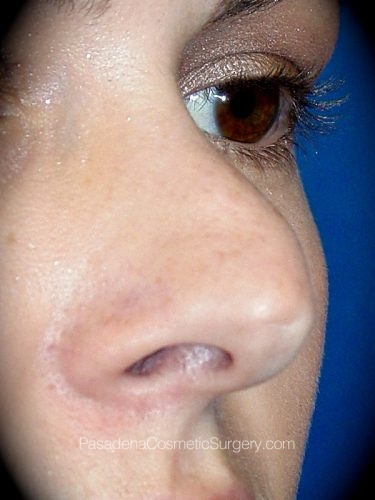 Rhinoplasty Patient 01 Before - 2