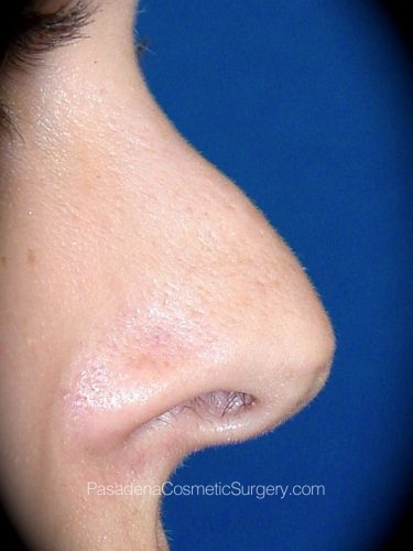 Rhinoplasty Patient 01 Before - 3
