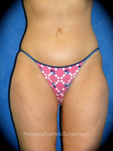 Thighplasty Patient 01 After