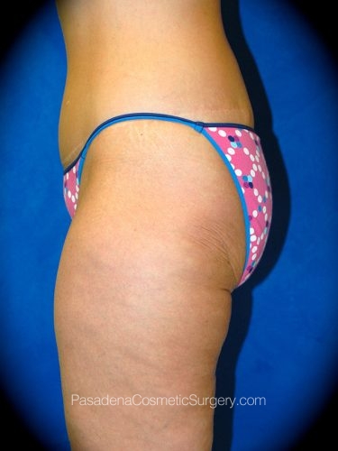 Thighplasty Patient 01 After - 2