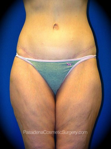 Thighplasty Patient 01 Before