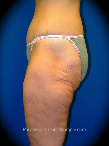 Thighplasty Patient 01 Before - 2