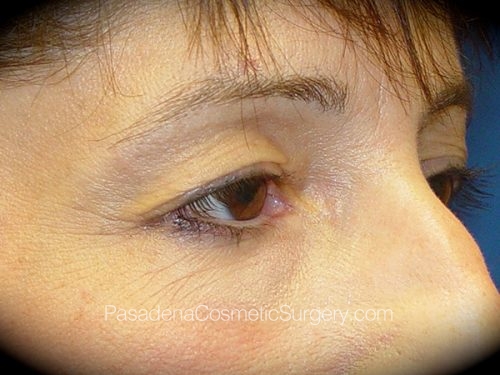 Eyelid Surgery Patient 08 Before - 2