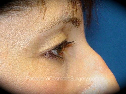 Eyelid Surgery Patient 08 Before - 3