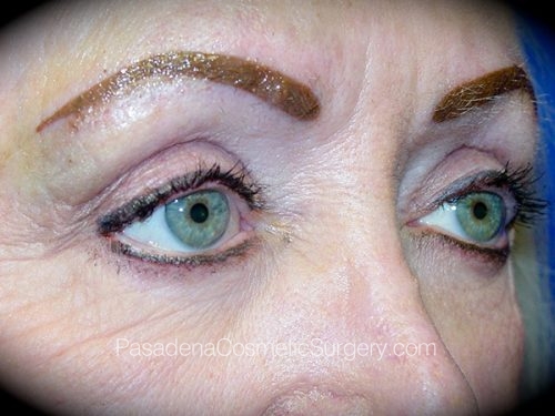 Eyelid Surgery Patient 09 After - 2