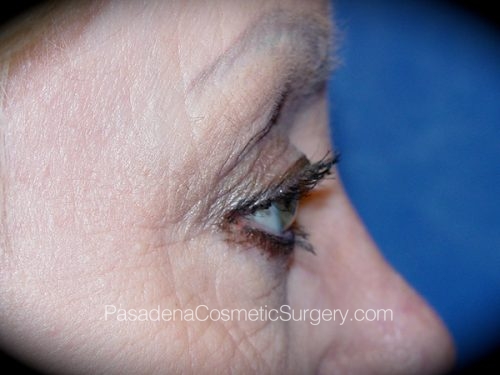 Eyelid Surgery Patient 09 After - 3