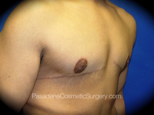 Gynecomastia Patient 02 After - 2