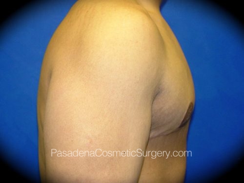 Gynecomastia Patient 02 After - 3