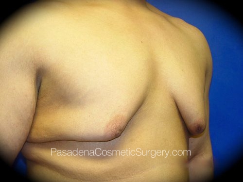 Gynecomastia Patient 02 Before - 2