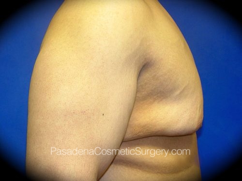 Gynecomastia Patient 02 Before - 3