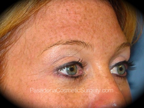 Brow Lift Patient 03 After - 2