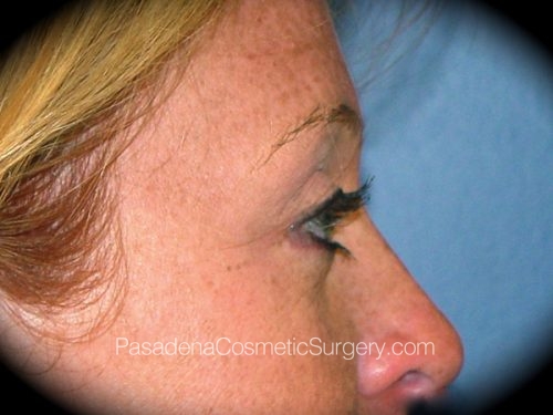 Brow Lift Patient 03 After - 3