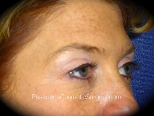 Brow Lift Patient 03 Before - 2