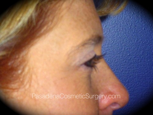 Brow Lift Patient 03 Before - 3
