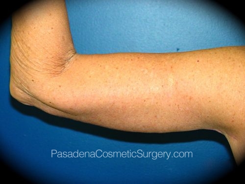 Arm Lift Patient 06 After - 2