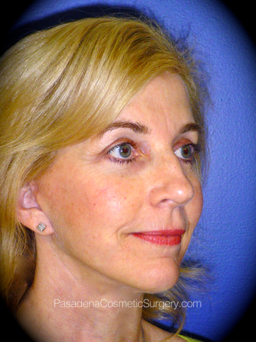 Facelift Patient 06 After - 2