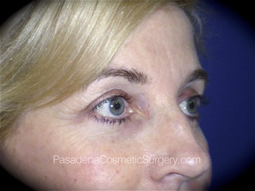 Eyelid Surgery Patient 10 After - 2