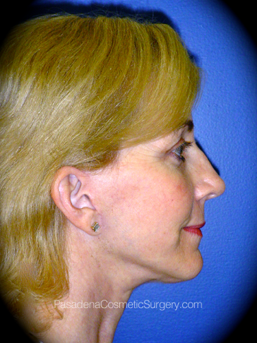 Facelift Patient 06 After - 3