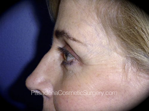 Eyelid Surgery Patient 10 After - 3