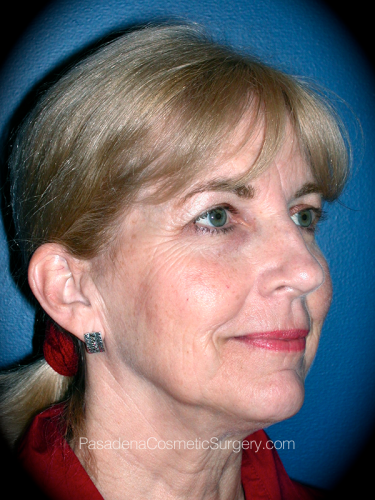 Facelift Patient 06 Before - 2