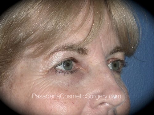 Eyelid Surgery Patient 10 Before - 2
