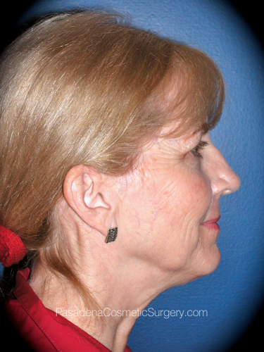 Facelift Patient 06 Before - 3