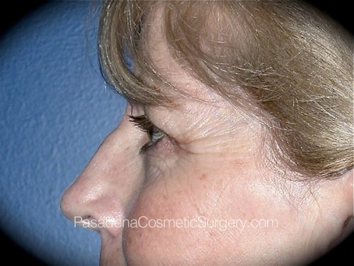Eyelid Surgery Patient 10 Before - 3