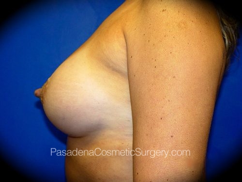 Breast Augmentation Patient 10 After - 3