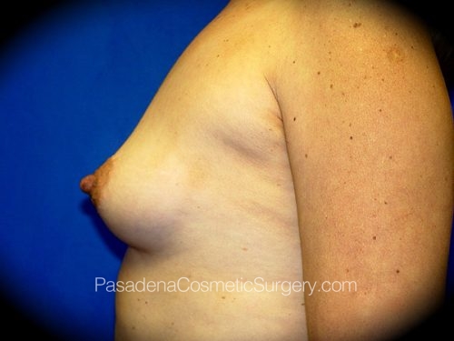 Breast Augmentation Patient 10 Before - 3