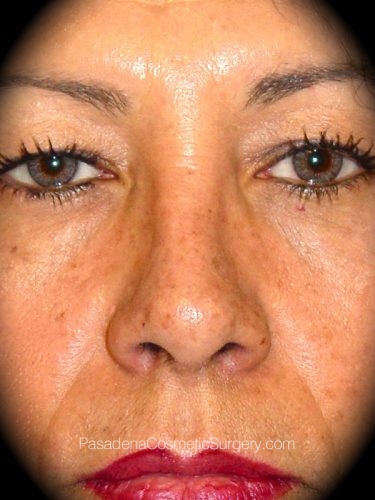 Rhinoplasty Patient 02 After