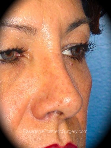Rhinoplasty Patient 02 After - 2
