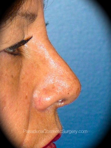 Rhinoplasty Patient 02 After - 3