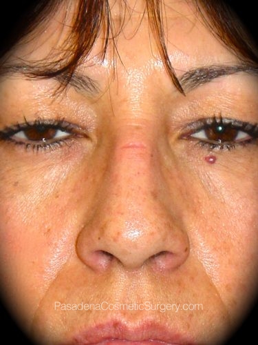 Rhinoplasty Patient 02 Before