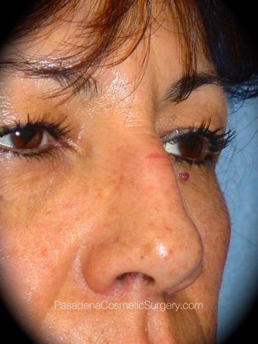 Rhinoplasty Patient 02 Before - 2