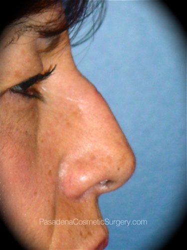 Rhinoplasty Patient 02 Before - 3