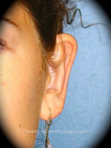 Ear Surgery Patient 01 After