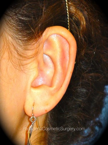 Ear Surgery Patient 01 After - 2