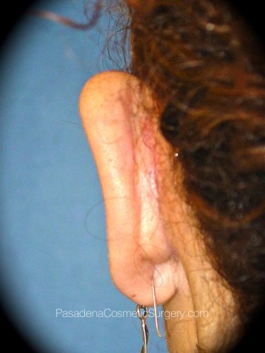 Ear Surgery Patient 01 After - 3
