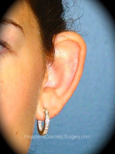 Ear Surgery Patient 01 Before