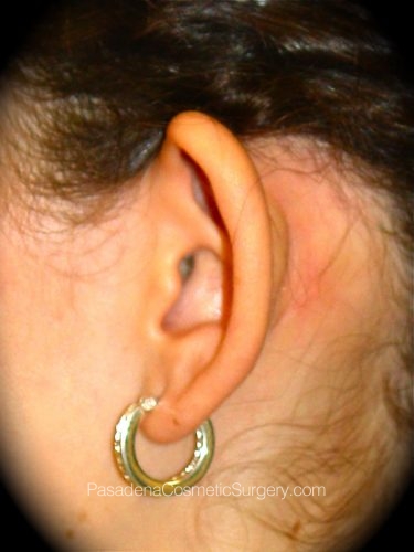 Ear Surgery Patient 01 Before - 2