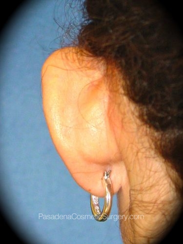 Ear Surgery Patient 01 Before - 3