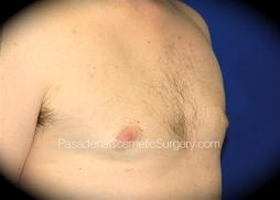 Gynecomastia Patient 06 After