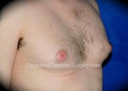 Gynecomastia Patient 06 Before