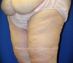 Thighplasty Patient 05 After